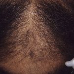 alopecie de traction endommage les follicules