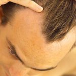 genes responsables 90% perte cheveux -hommes