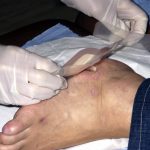 Les blessures aux pieds peuvent etre graves