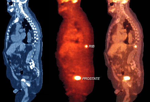 definir-le-stade-du-cancer-de-la-prostate