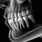Plus d’implants dentaires, un dentiste fait pousser de nouvelles dents en seulement 9 semaines !