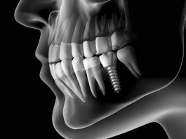 Plus d'implants dentaires, un dentiste fait pousser de nouvelles dents en seulement 9 semaines !