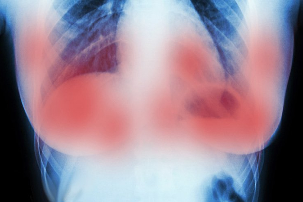 Cancer du sein, un traitement combiné fait fondre les tumeurs en 11 jours, sans chimio !